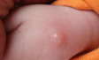 4月份健康提醒：麻疹、手足口病等进入高发期