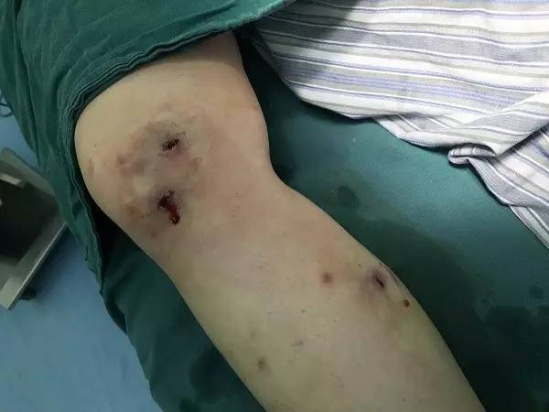 女子巴西旅游被虫咬 1个月后腿中出2条活虫(图